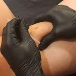 Dr Ian the Chiro using the dry needling technique as part of an athletes recovery_2