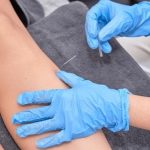 Dry Needling-knee