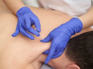 Dry needling applied on the upper back. | Photo by Jose Luis Montoya Retamosa / Shutterstock / NHA File Photo